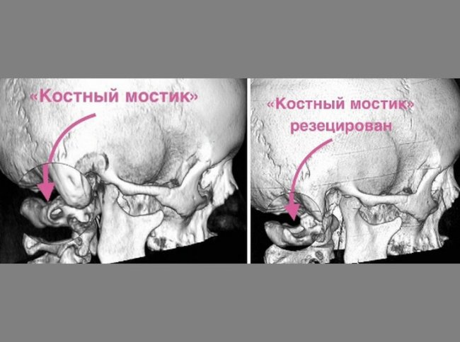 Воронежские нейрохирурги спасли пациентку от 15-летних болей