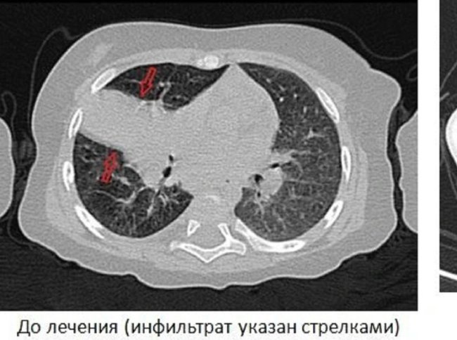 В Ярославской области медикам пришлось лечить трехмесячного младенца от туберкулеза